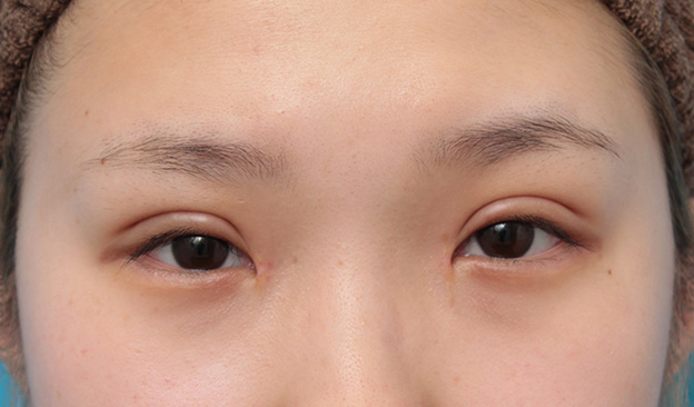 症例写真,目頭切開、眼瞼下垂手術、タレ目形成を同時に行った症例写真,3週間後,目を開けた状態,mainpic_megashira054f.jpg