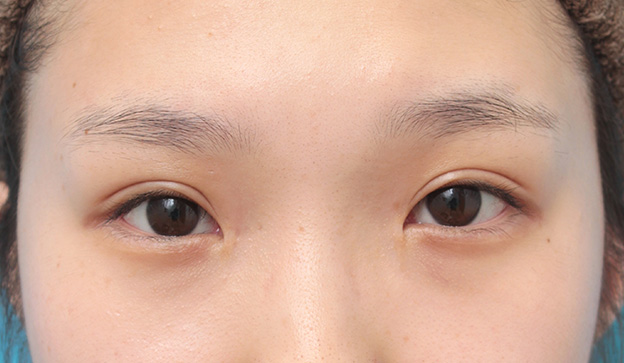 症例写真,目頭切開、眼瞼下垂手術、タレ目形成を同時に行った症例写真,6ヶ月後,目を開けた状態,mainpic_megashira054j.jpg