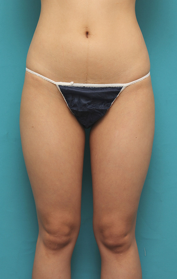 症例写真,20代前半の痩せている女性の太ももとお尻から脂肪吸引し、バストに脂肪注入した症例写真,Before,ba_inject021_b04.jpg