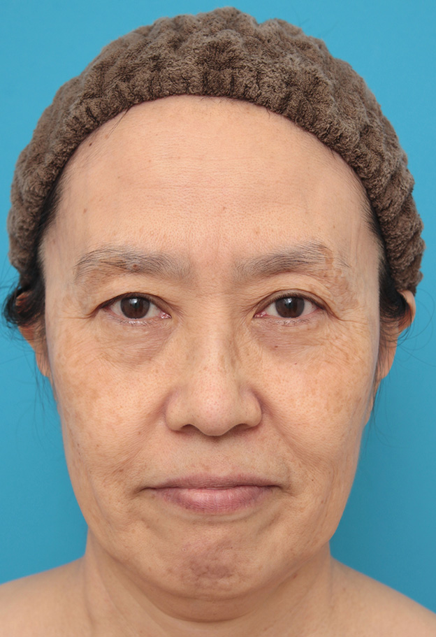 症例写真,ミニフェイスリフト（頬のたるみ取り）で頬のたるみを改善させた60代女性の症例写真,手術前,mainpic_minilift006a.jpg