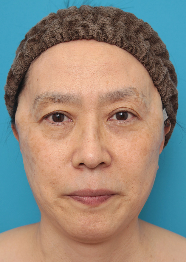 症例写真,ミニフェイスリフト（頬のたるみ取り）で頬のたるみを改善させた60代女性の症例写真,手術直後,mainpic_minilift006b.jpg