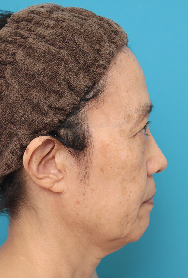 症例写真,ミニフェイスリフト（頬のたるみ取り）で頬のたるみを改善させた60代女性の症例写真,手術前,mainpic_minilift006e.jpg