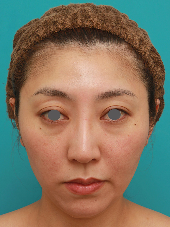 症例写真,小顔専用脂肪溶解注射メソシェイプフェイスで頬、フェイスライン、顎下の皮下脂肪を溶かした30代後半女性の症例写真,After（3回目注射後2ヶ月）,ba_meso_face005_b01.jpg