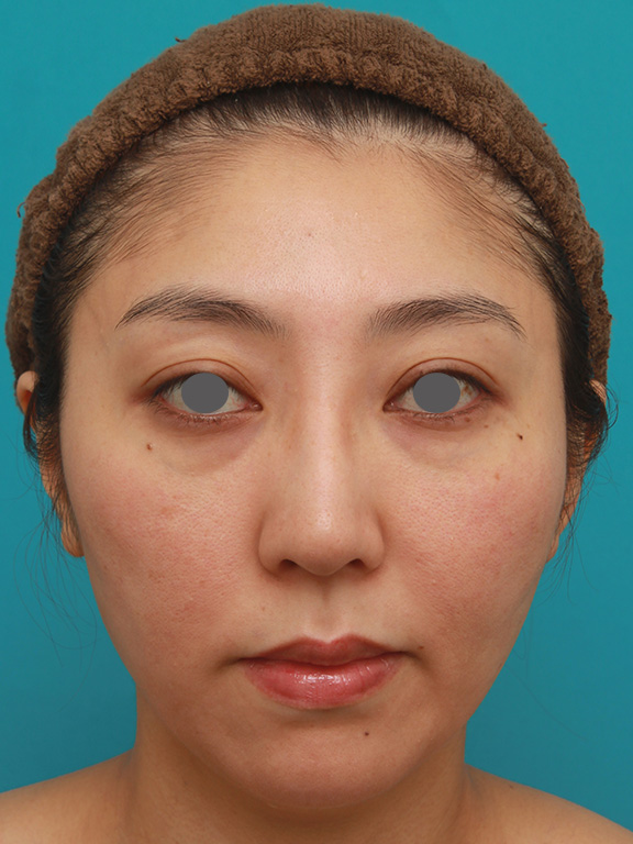 小顔専用脂肪溶解注射メソシェイプフェイスで頬、フェイスライン、顎下の皮下脂肪を溶かした30代後半女性の症例写真,Before,ba_meso_face005_b01.jpg