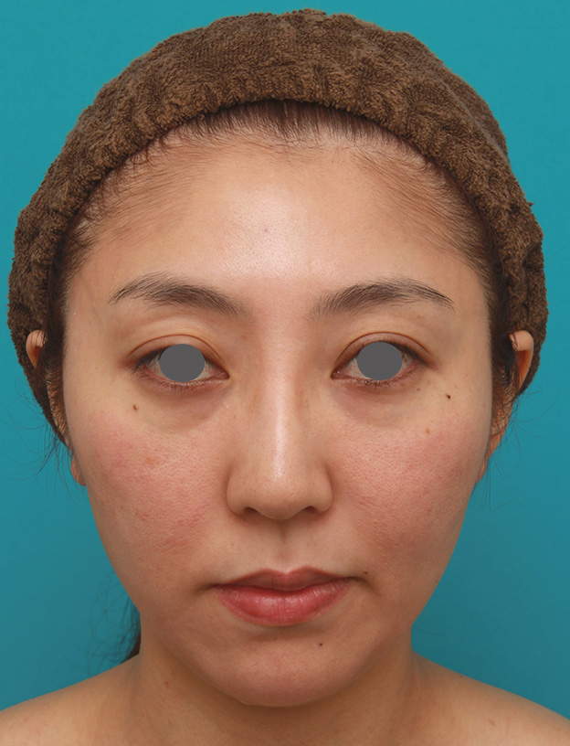 症例写真,小顔専用脂肪溶解注射メソシェイプフェイスで頬、フェイスライン、顎下の皮下脂肪を溶かした30代後半女性の症例写真,1回目注射後1ヶ月,mainpic_meso_face005c.jpg
