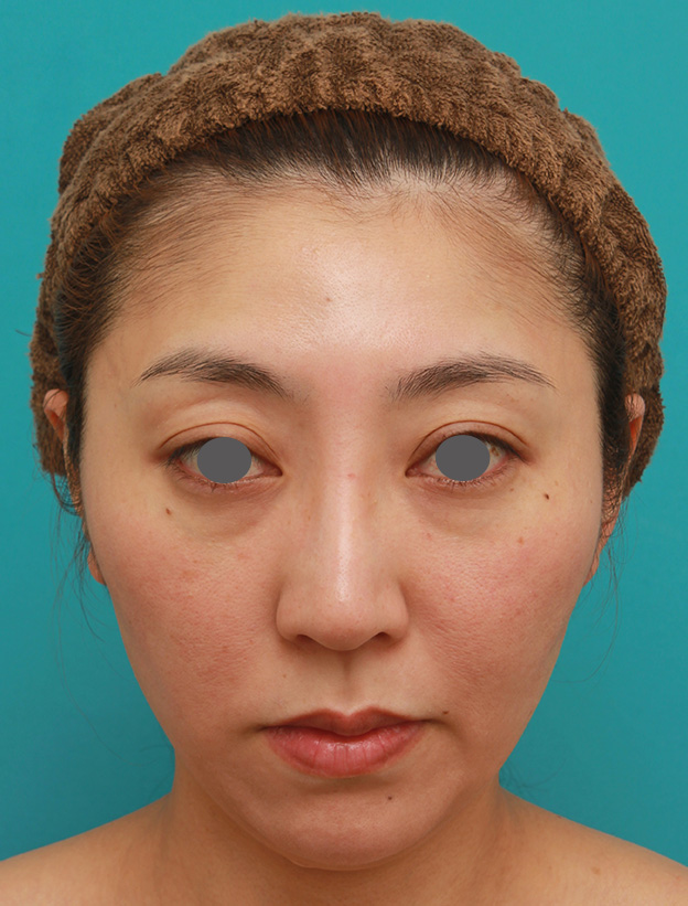 症例写真,小顔専用脂肪溶解注射メソシェイプフェイスで頬、フェイスライン、顎下の皮下脂肪を溶かした30代後半女性の症例写真,3回目注射後2ヶ月,mainpic_meso_face005e.jpg