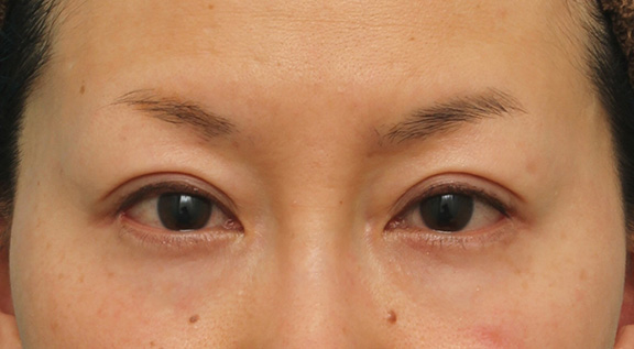 40代女性に目尻切開を行って目を外側に大きくした症例写真,After（7ヶ月後）,ba_mejiri017_a01.jpg