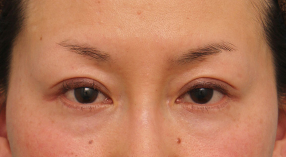症例写真,40代女性に目尻切開を行って目を外側に大きくした症例写真,Before,ba_mejiri017_b01.jpg