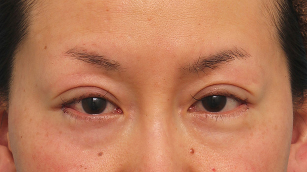 症例写真,40代女性に目尻切開を行って目を外側に大きくした症例写真,手術直後,mainpic_mejiri017b.jpg