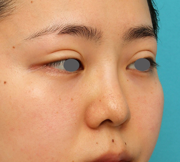 症例写真,横に広がらない流れない鼻の長期持続型ヒアルロン酸注射の症例写真,After（1年後）,ba_ryubi2030_b02.jpg