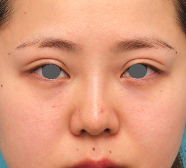症例写真,横に広がらない流れない鼻の長期持続型ヒアルロン酸注射の症例写真,1週間後,mainpic_ryubi2030c.jpg