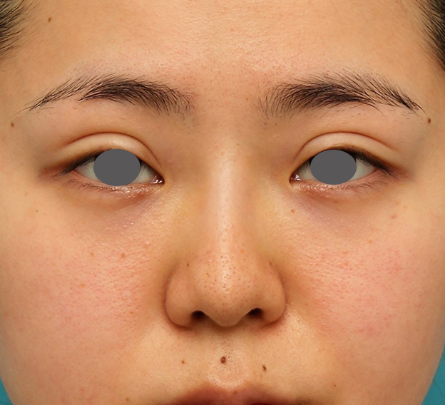 症例写真,横に広がらない流れない鼻の長期持続型ヒアルロン酸注射の症例写真,1年後,mainpic_ryubi2030d.jpg
