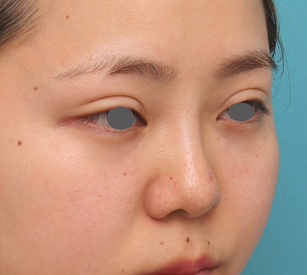 症例写真,横に広がらない流れない鼻の長期持続型ヒアルロン酸注射の症例写真,1週間後,mainpic_ryubi2030g.jpg
