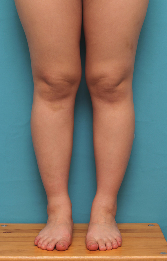 症例写真,20代女性の発達したふくらはぎの筋肉をボツリヌストキシン注射で細くした症例写真,After（3ヶ月後）,ba_leg010_b03.jpg