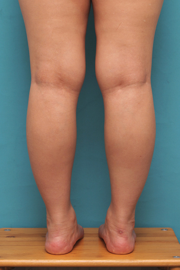 20代女性の発達したふくらはぎの筋肉をボツリヌストキシン注射で細くした症例写真,Before,ba_leg010_b01.jpg