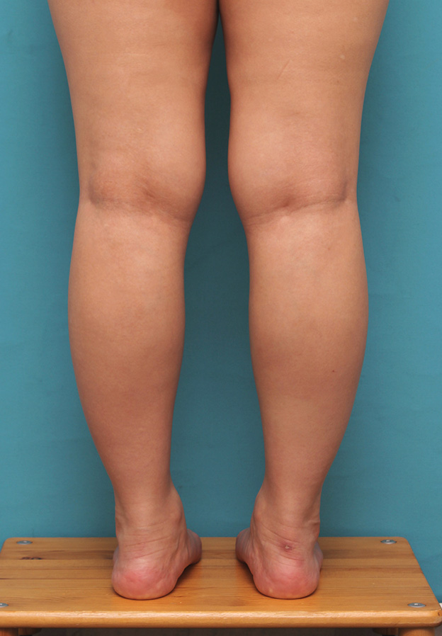 症例写真,20代女性の発達したふくらはぎの筋肉をボツリヌストキシン注射で細くした症例写真,治療前,mainpic_leg010a.jpg