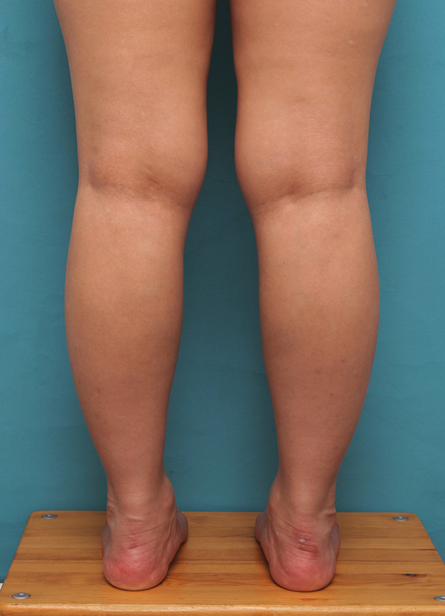 症例写真,20代女性の発達したふくらはぎの筋肉をボツリヌストキシン注射で細くした症例写真,注射後1週間,mainpic_leg010c.jpg