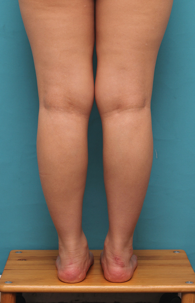 症例写真,20代女性の発達したふくらはぎの筋肉をボツリヌストキシン注射で細くした症例写真,注射後3ヶ月,mainpic_leg010e.jpg