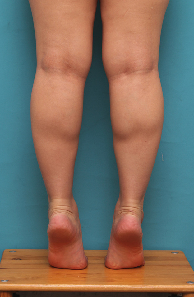 症例写真,20代女性の発達したふくらはぎの筋肉をボツリヌストキシン注射で細くした症例写真,治療前,mainpic_leg010f.jpg