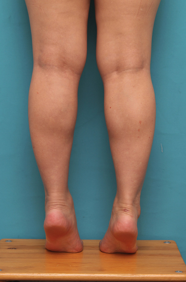 症例写真,20代女性の発達したふくらはぎの筋肉をボツリヌストキシン注射で細くした症例写真,注射直後,mainpic_leg010g.jpg