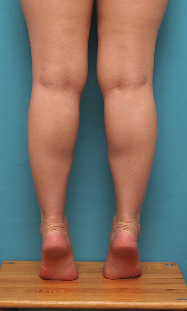 症例写真,20代女性の発達したふくらはぎの筋肉をボツリヌストキシン注射で細くした症例写真,注射後1週間,mainpic_leg010h.jpg