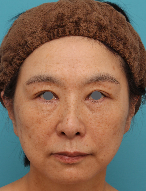 症例写真,ミディアムフェイスリフトで頬のたるみをリフトアップさせた50代後半女性の症例写真,After（6ヶ月後）,ba_mediumlift008_b01.jpg