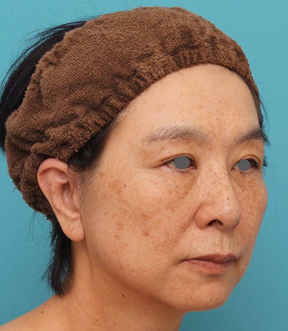 症例写真,ミディアムフェイスリフトで頬のたるみをリフトアップさせた50代後半女性の症例写真,After（6ヶ月後）,ba_mediumlift008_b02.jpg