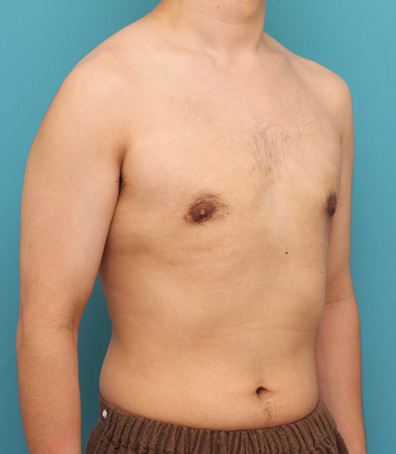 症例写真,真性女性化乳房の乳腺除去手術の症例写真,After(8ヶ月後),ba_gynecomastia010_b02.jpg