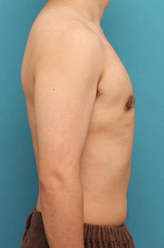 症例写真,真性女性化乳房の乳腺除去手術の症例写真,After(8ヶ月後),ba_gynecomastia010_b03.jpg