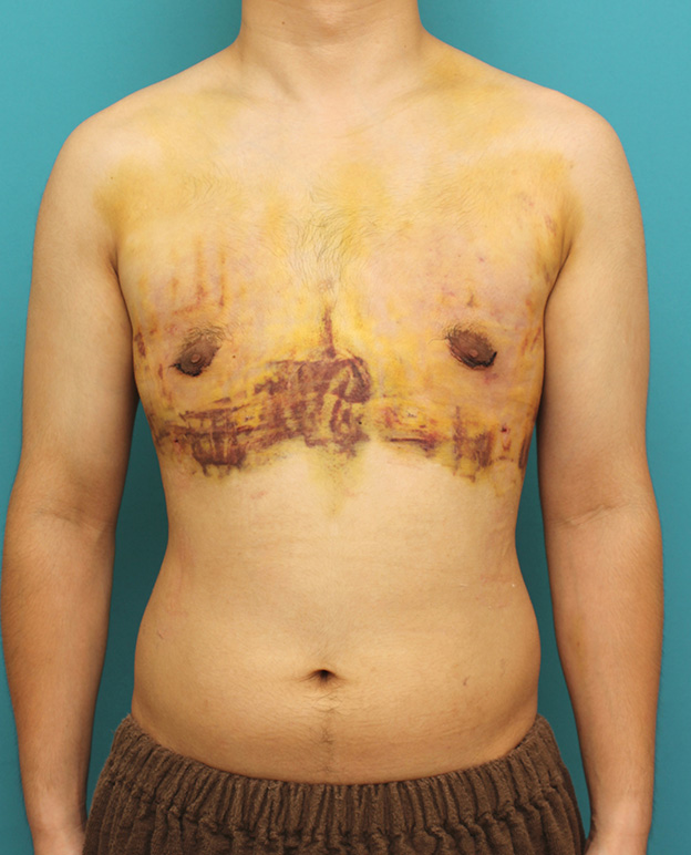症例写真,真性女性化乳房の乳腺除去手術の症例写真,3日後,mainpic_gynecomastia010c.jpg