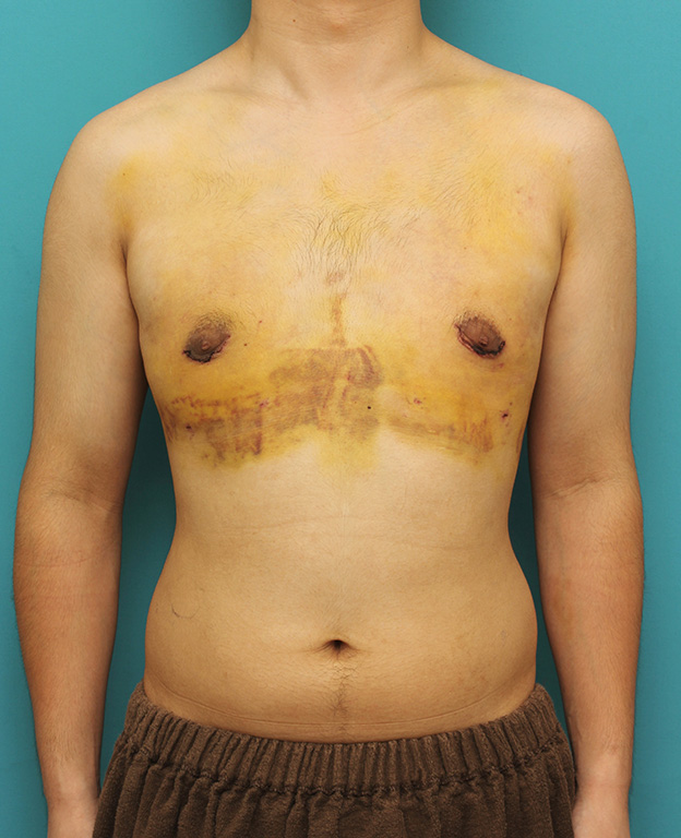 症例写真,真性女性化乳房の乳腺除去手術の症例写真,1週間後,mainpic_gynecomastia010d.jpg