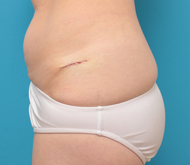 症例写真,若い女性の腰の入れ墨を切除縫縮手術で除去した症例写真,手術直後,mainpic_irezumi033b.jpg