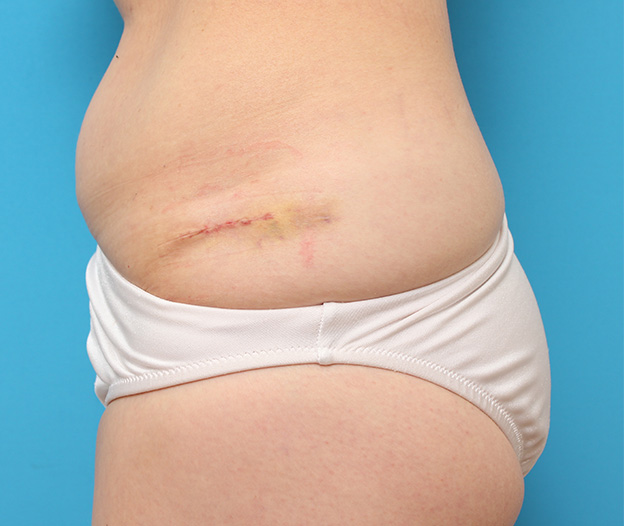 症例写真,若い女性の腰の入れ墨を切除縫縮手術で除去した症例写真,1週間後,mainpic_irezumi033c.jpg