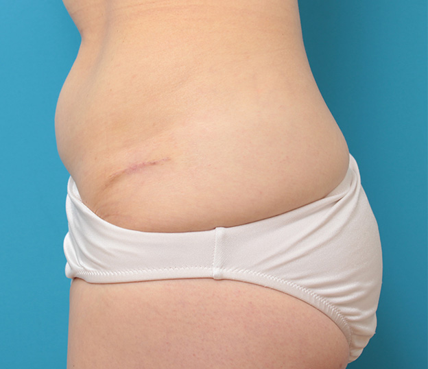 症例写真,若い女性の腰の入れ墨を切除縫縮手術で除去した症例写真,3週間後,mainpic_irezumi033d.jpg