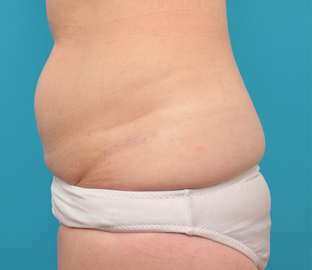 症例写真,若い女性の腰の入れ墨を切除縫縮手術で除去した症例写真,1年後,mainpic_irezumi033g.jpg
