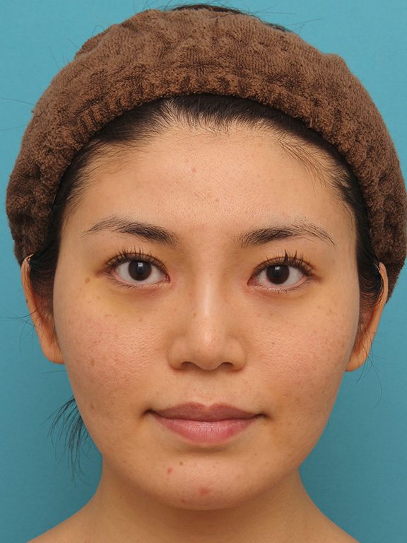 症例写真,イタリアンリフトで頬のたるみをリフトアップした30代女性の症例写真,After（6ヶ月後）,ba_italian020_b01.jpg