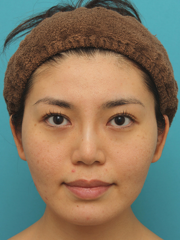 症例写真,イタリアンリフトで頬のたるみをリフトアップした30代女性の症例写真,2ヶ月後,mainpic_italian020c.jpg