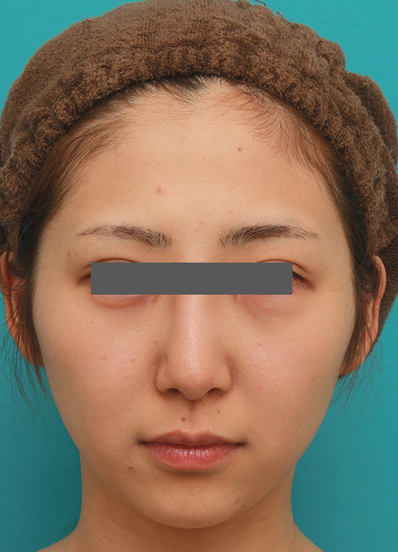 小顔専用脂肪溶解注射メソシェイプフェイスで小顔になった症例写真,After（5回目注射後3週間）,ba_meso_face006_a01.jpg