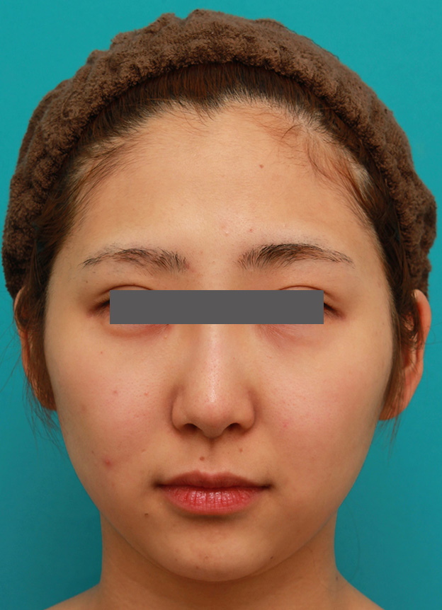 症例写真,小顔専用脂肪溶解注射メソシェイプフェイスで小顔になった症例写真,2回目注射後2ヶ月,mainpic_meso_face006d.jpg