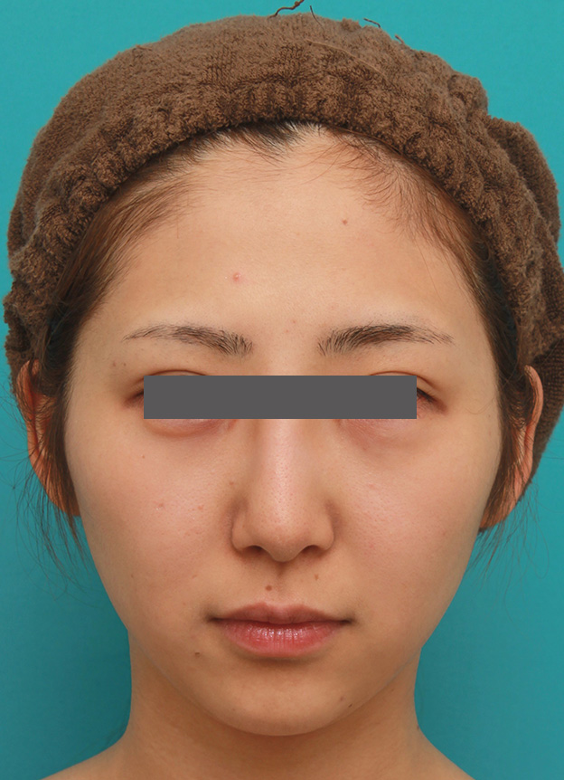 症例写真,小顔専用脂肪溶解注射メソシェイプフェイスで小顔になった症例写真,5回目注射後3週間,mainpic_meso_face006g.jpg