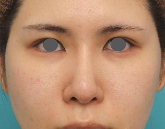 鼻のシリコンプロテーゼ+鼻先の耳介軟骨移植の症例写真,After（6ヶ月後）,ba_jikai040_a01.jpg