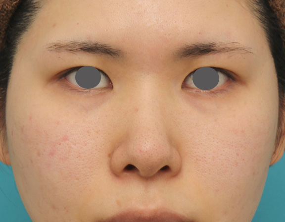 症例写真,鼻のシリコンプロテーゼ+鼻先の耳介軟骨移植の症例写真,Before,ba_jikai040_b01.jpg