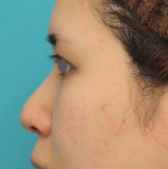 症例写真,鼻のシリコンプロテーゼ+鼻先の耳介軟骨移植の症例写真,Before,ba_jikai040_b03.jpg