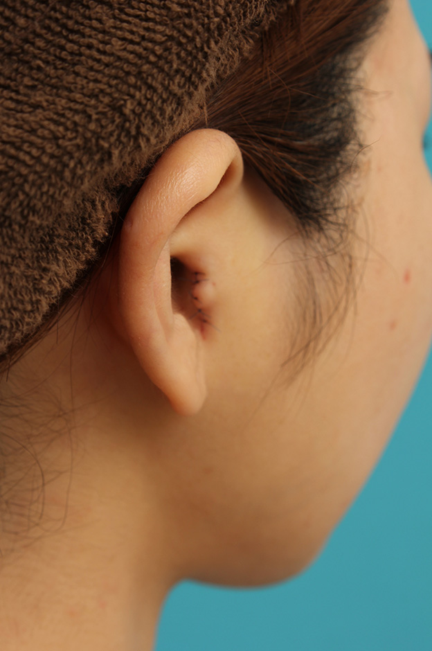 症例写真,鼻のシリコンプロテーゼ+鼻先の耳介軟骨移植の症例写真,手術直後,手術直後の耳の状態,mainpic_jikai040c.jpg