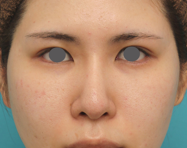 症例写真,鼻のシリコンプロテーゼ+鼻先の耳介軟骨移植の症例写真,6ヶ月後,mainpic_jikai040f.jpg