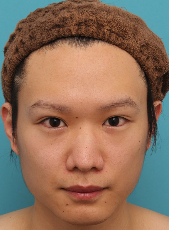 症例写真,目頭切開でかなり目を内側に大きく広げた男性の症例写真,After（2年11ヶ月後）,ba_megashira056_b01.jpg