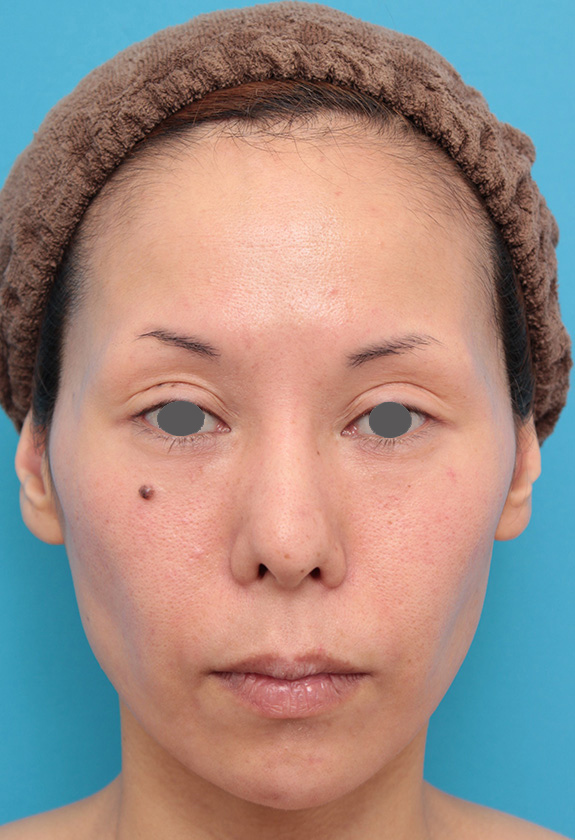 ヒアルロン酸注射で顎先を前方に出した30代女性の症例写真,After（1ヶ月後）,ba_agochu012_a01.jpg