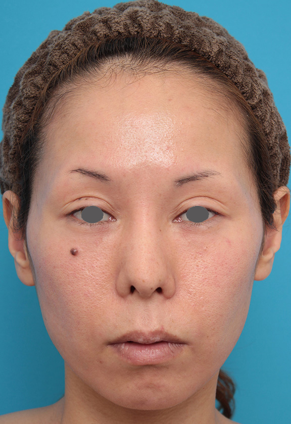 あご注射（ヒアルロン酸）,ヒアルロン酸注射で顎先を前方に出した30代女性の症例写真,Before,ba_agochu012_b01.jpg