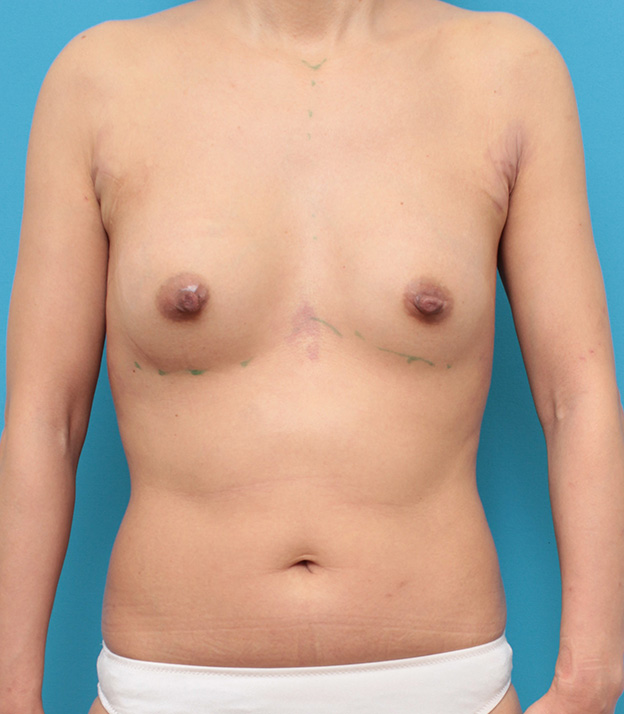 症例写真,左右の大きさが違うバストにシリコンバッグプロテーゼ豊胸手術を行った症例写真,手術直後,mainpic_hokyo027b.jpg