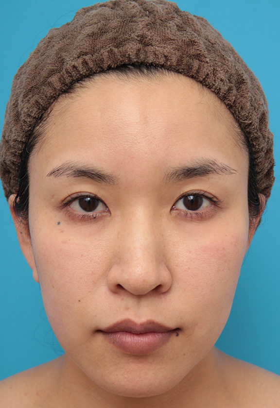 30代女性にウルセラシステムを行い、たるんだ頬と顎下を引き締め、リフトアップした症例写真,After（3ヶ月後）,ba_ulthera022_a01.jpg